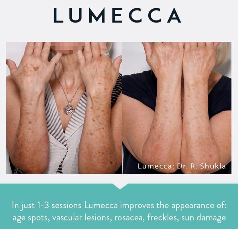 IPL Lumecca