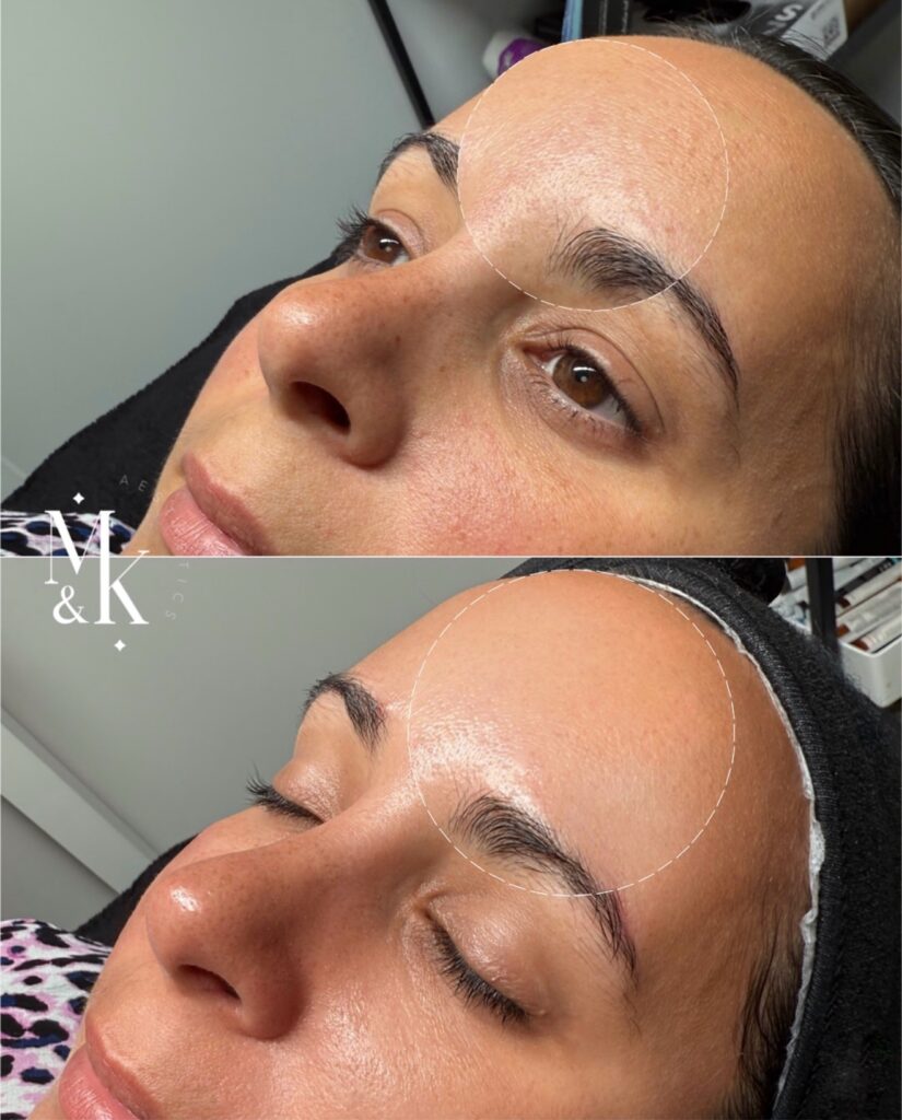 HydraFacial