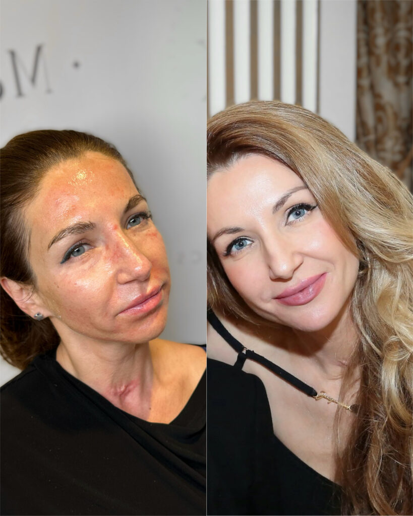 Morpheus8 RF Microneedling & Skin Tightening