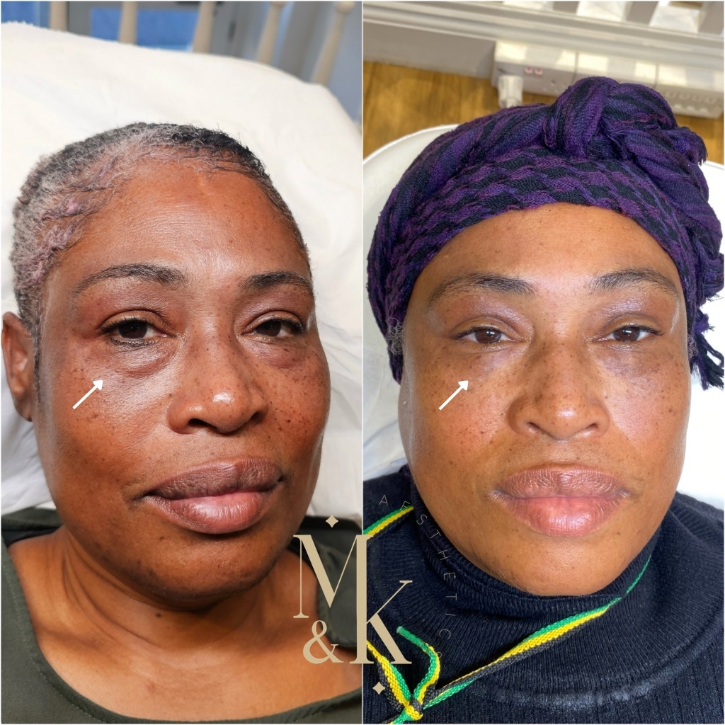 Morpheus8 RF Microneedling & Skin Tightening