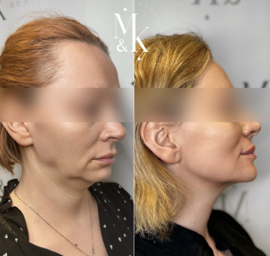 Morpheus8 RF Microneedling & Skin Tightening