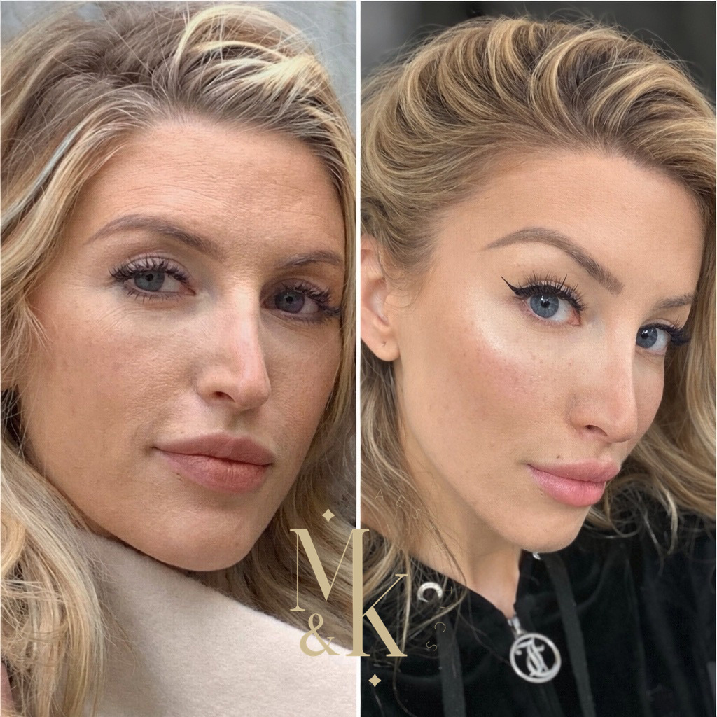 Morpheus8 RF Microneedling & Skin Tightening