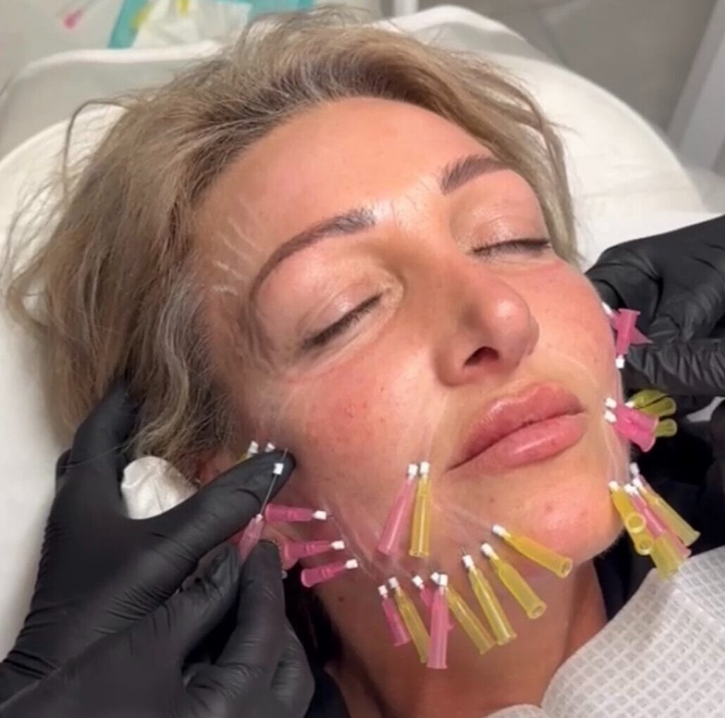 PDO Threads – Skin Rejuvenation Treatment