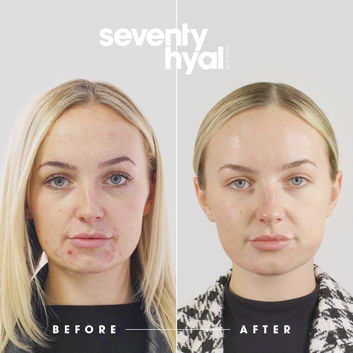 Seventy Hyal 2000 – Hydration Skin Booster