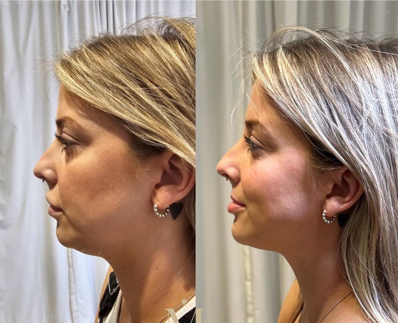 Fat Dissolving Injections