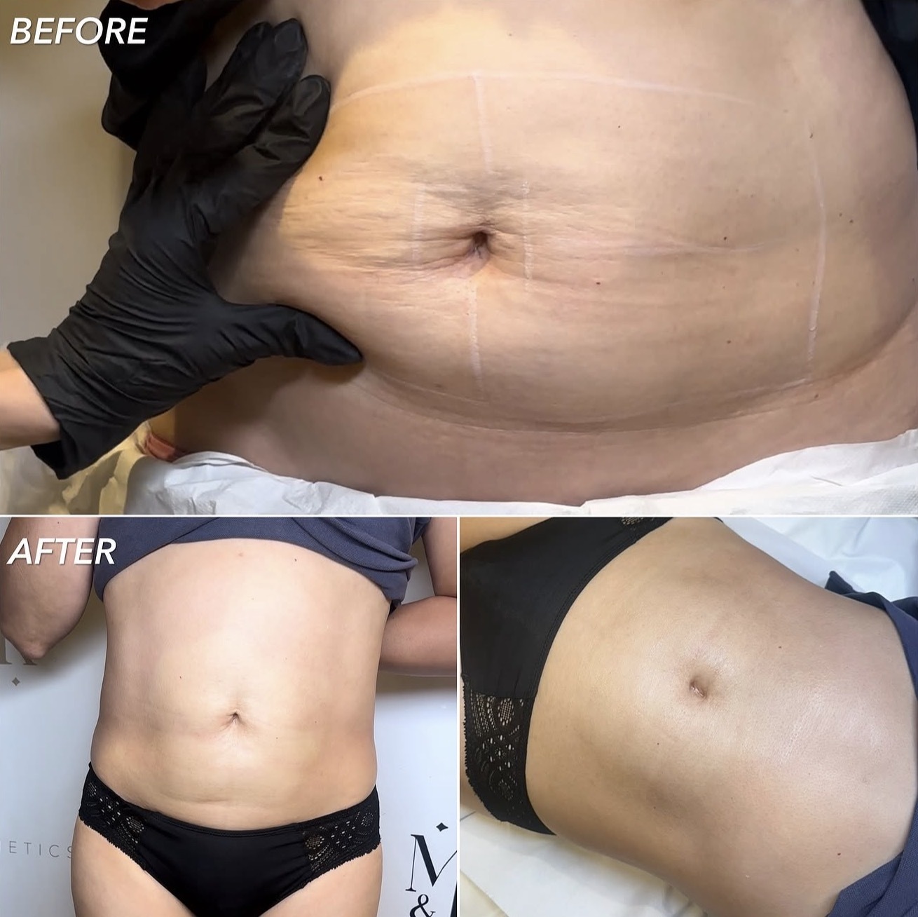 Fat Dissolving Injections